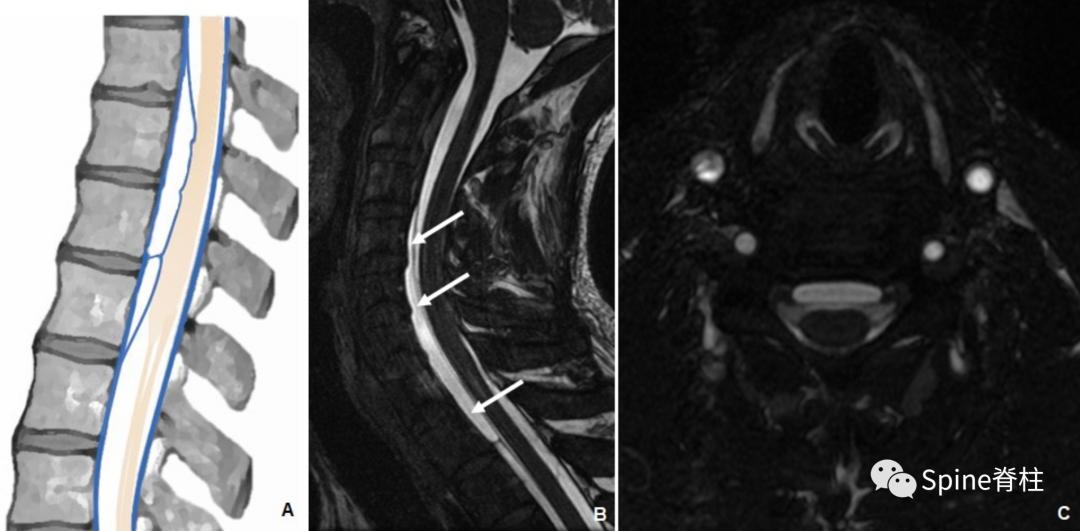 腰椎椎管有囊性结构,水平椎管内囊性占位