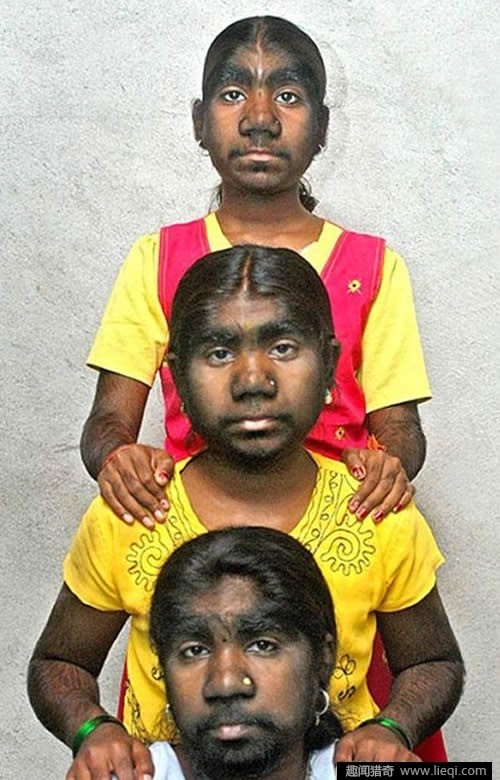 故事:非洲17岁女孩长满络腮胡,毛发从鼻孔长到脖子,身体有何异常