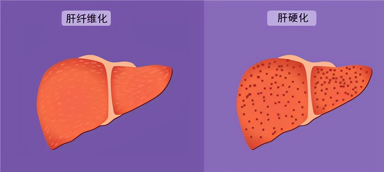 谷丙转氨酶高出多少是肝癌,谷丙转氨酶400谷草200会是肝癌吗