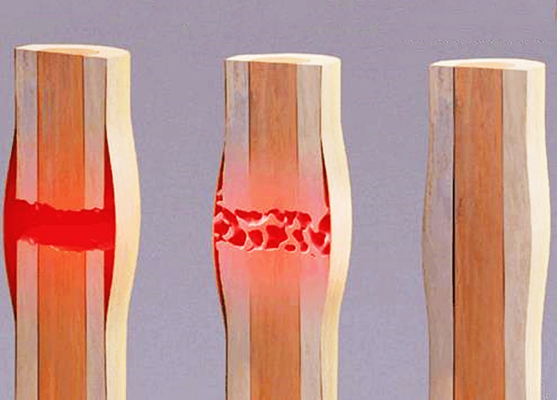 骨折恢复到怎么样就可以穿石膏了,骨折拆石膏后是完全愈合了吗