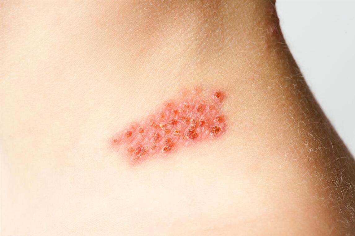 新冠带状疱疹症状和表现,新冠后带状疱疹发病率