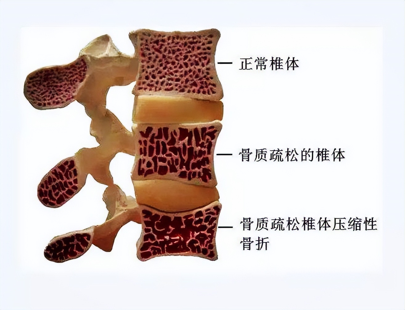 老年人闪腰岔气怎么治疗最快,66岁老年人闪腰治疗视频
