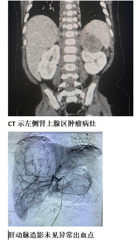 肾上腺肿瘤的介入栓塞治疗,肾上腺恶性肿瘤介入治疗