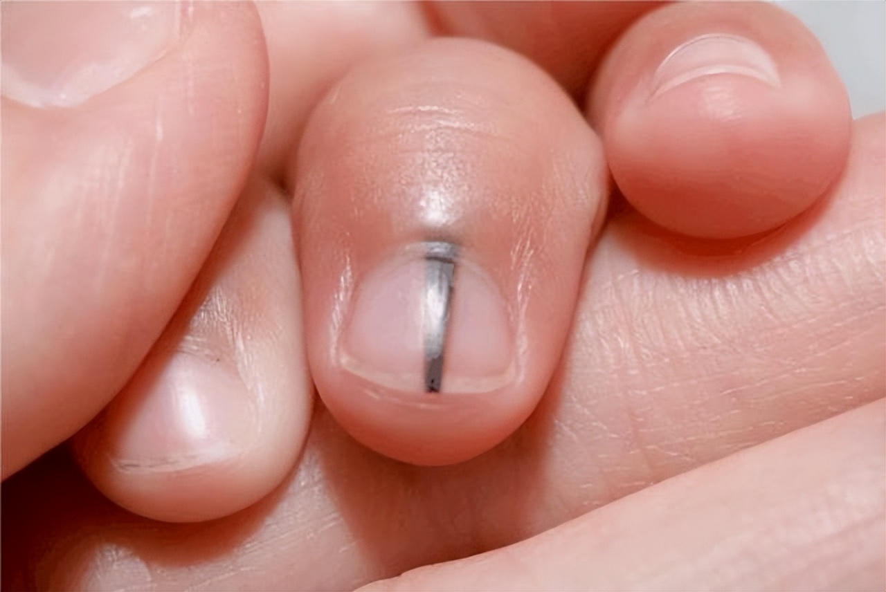 身体部位有黑痣和红痣是什么,痣黑如漆与深黑死痣区别