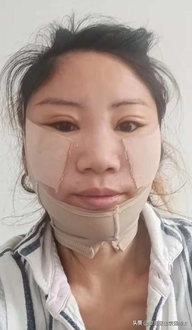 45岁做拉皮多少钱,北京做大拉皮前后对比照片图文