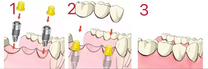 种植牙可怕吗360问答,种植牙可怕吗