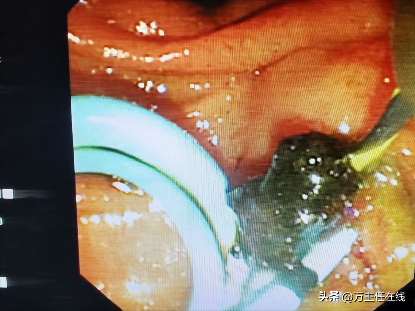 胆结石化脓性胆囊炎,妙手神针巧治疑难杂症