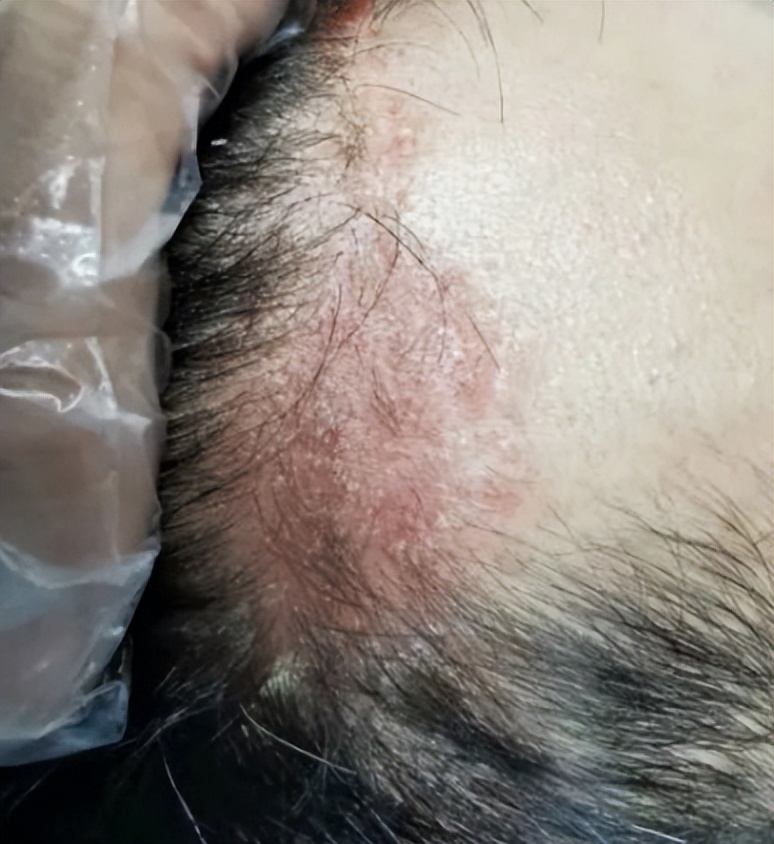 脂溢性皮炎头皮还能长头发么,头皮脂溢性皮炎与白头发有关