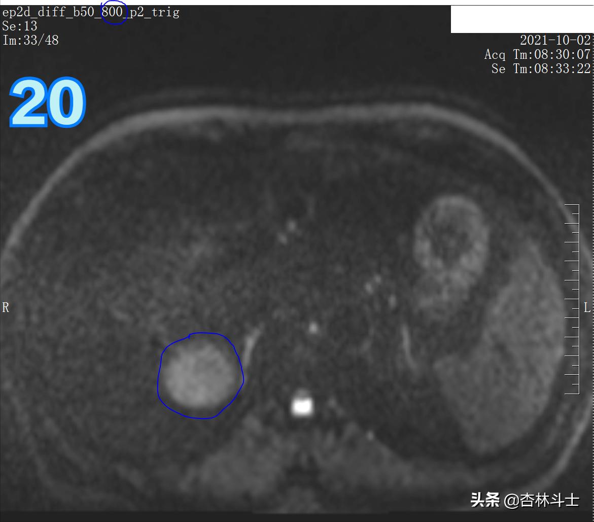 肝癌8公分肿瘤能活多久,肝癌细胞最大长多大