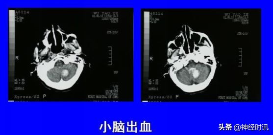 脑受撞击少量出血症状表现,脑动脉瘤出血的表现