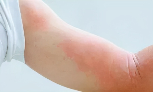 麻疹湿疹荨麻疹三者有什么区别,荨麻疹和湿疹断根的土方法