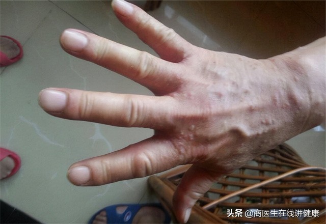 疥螨虫病怎么引起的,疥螨感染是什么意思