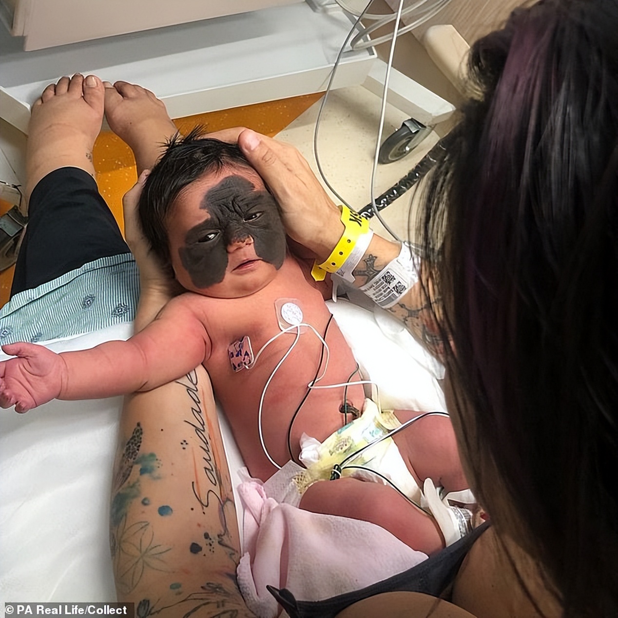 美国小女孩脸带“蝙蝠侠”黑印,治疗两年经过终于恢复肉色!