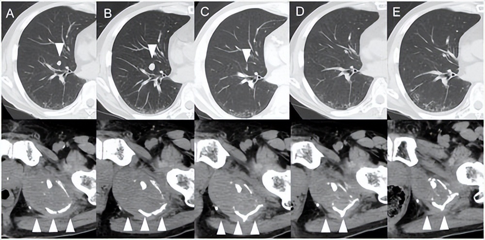 癌症患者用药后，肿瘤体积反而增加，要不要换药？