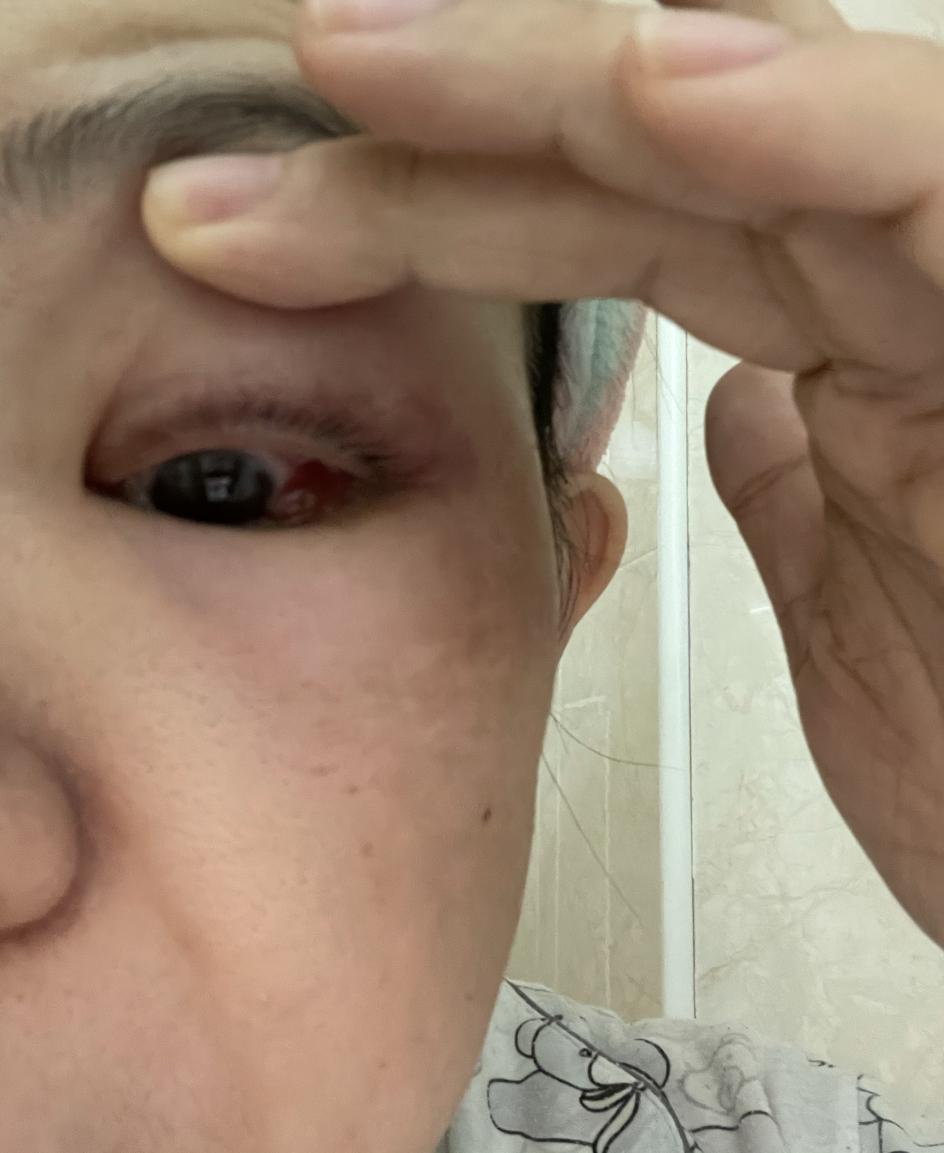 终于找到正确的医生治疗我的眼眶蜂窝织炎：详细记录住院康复经历