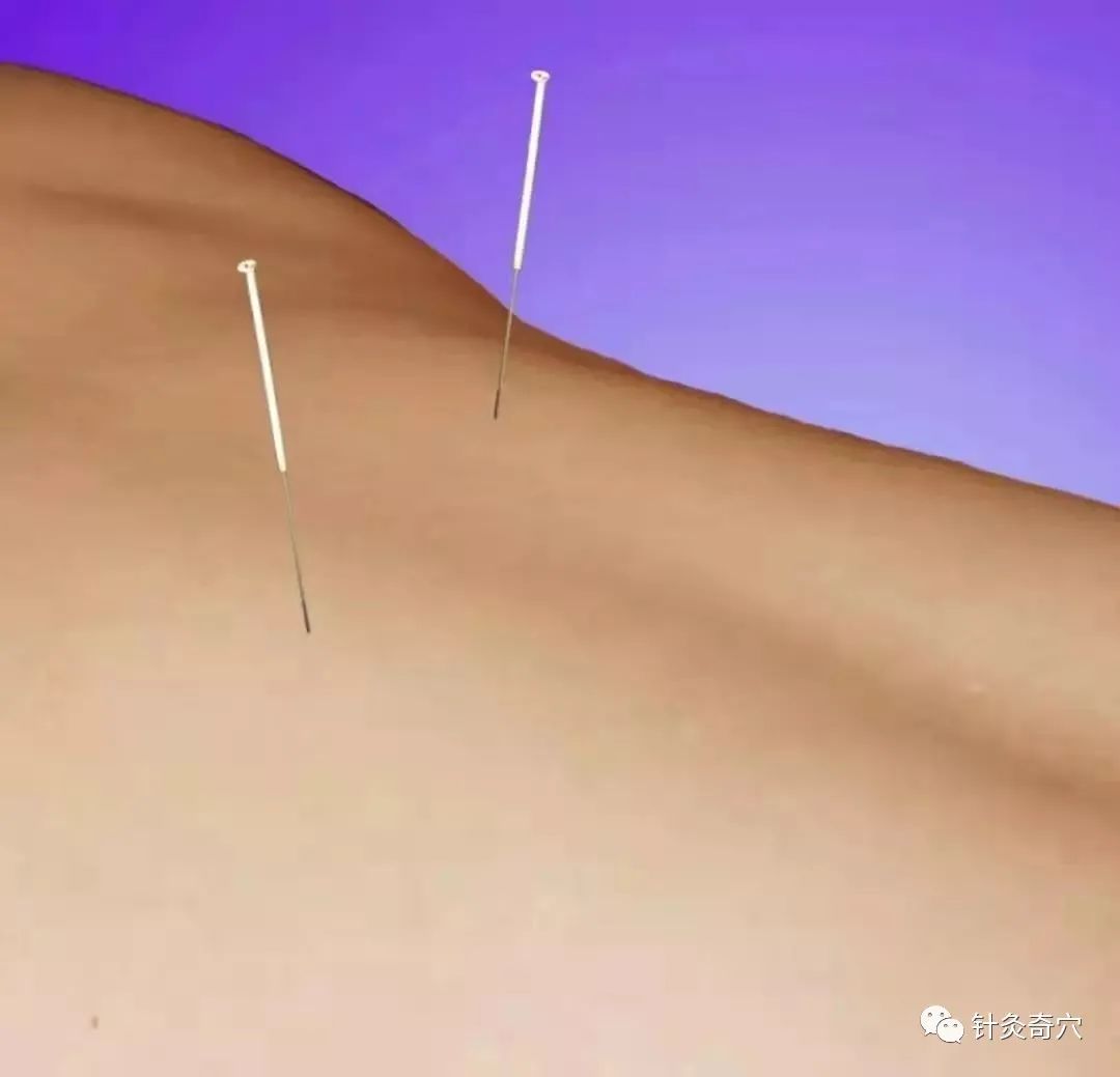 史上最全中医针灸视频教程全集,针灸治疗真实图片大全