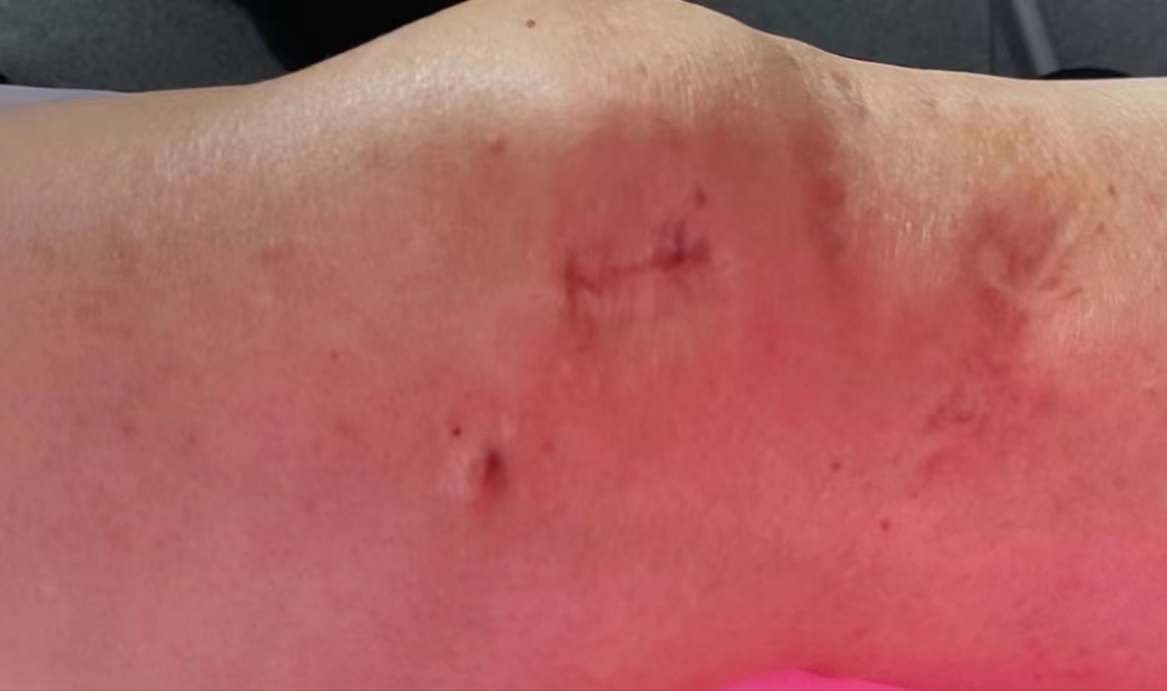 针灸的消毒操作规范,针灸会造成感染吗