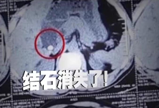 故事：湖北55岁男子病从口入，孕出成千上万虫卵，肚子竟成虫窝