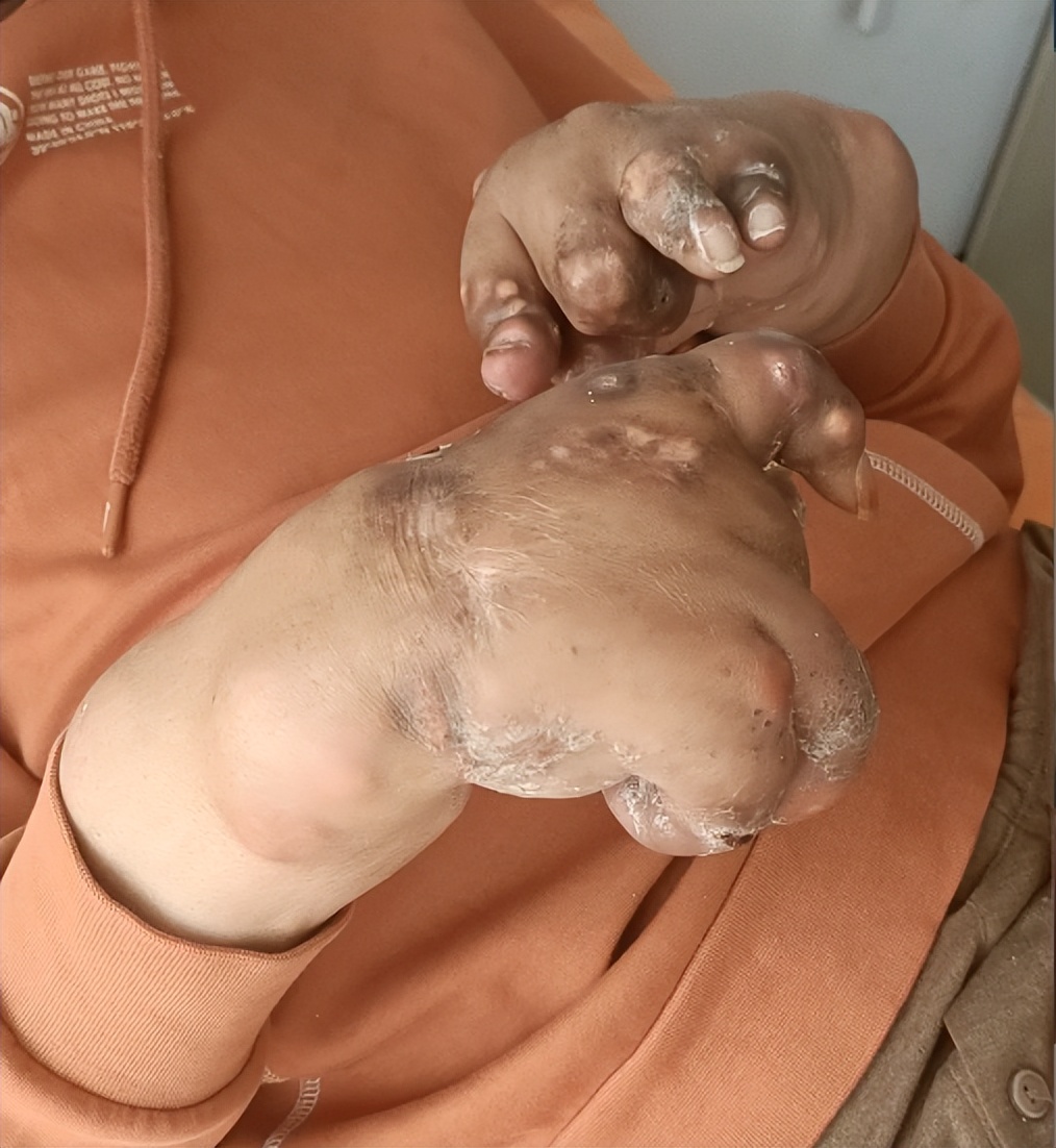 张仲景的痛风方子,张仲景治痛风是真的吗