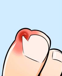 一走路脚趾甲里疼怎么回事,甲沟炎拔完脚趾甲很疼怎么办