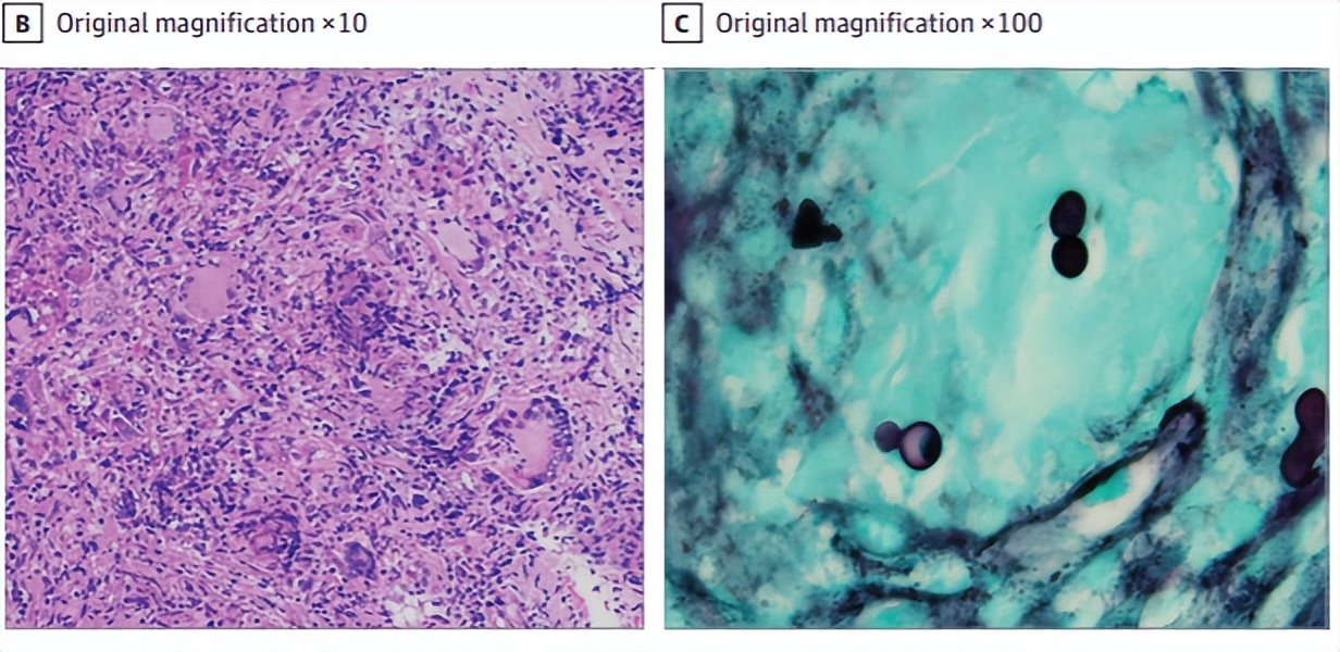 真菌进入口中会怎么样,喉咙真菌感染会致命吗