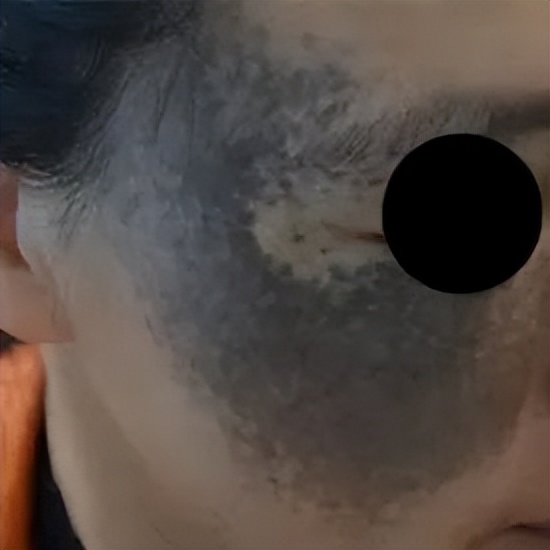 新生儿有胎记怎么办,新生儿有胎记是怎么造成的