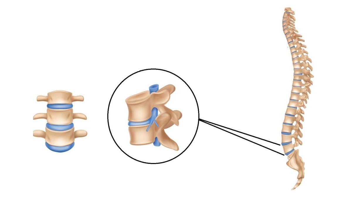 腰椎间盘核磁信号,腰椎间盘突出中央型核磁如何描述