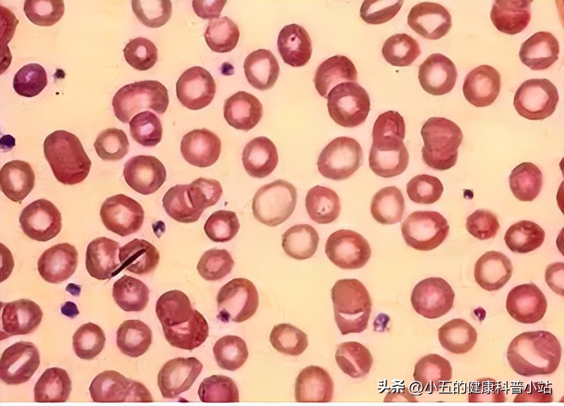 益气养血治疗贫血吗,生血宁片可以治贫血吗