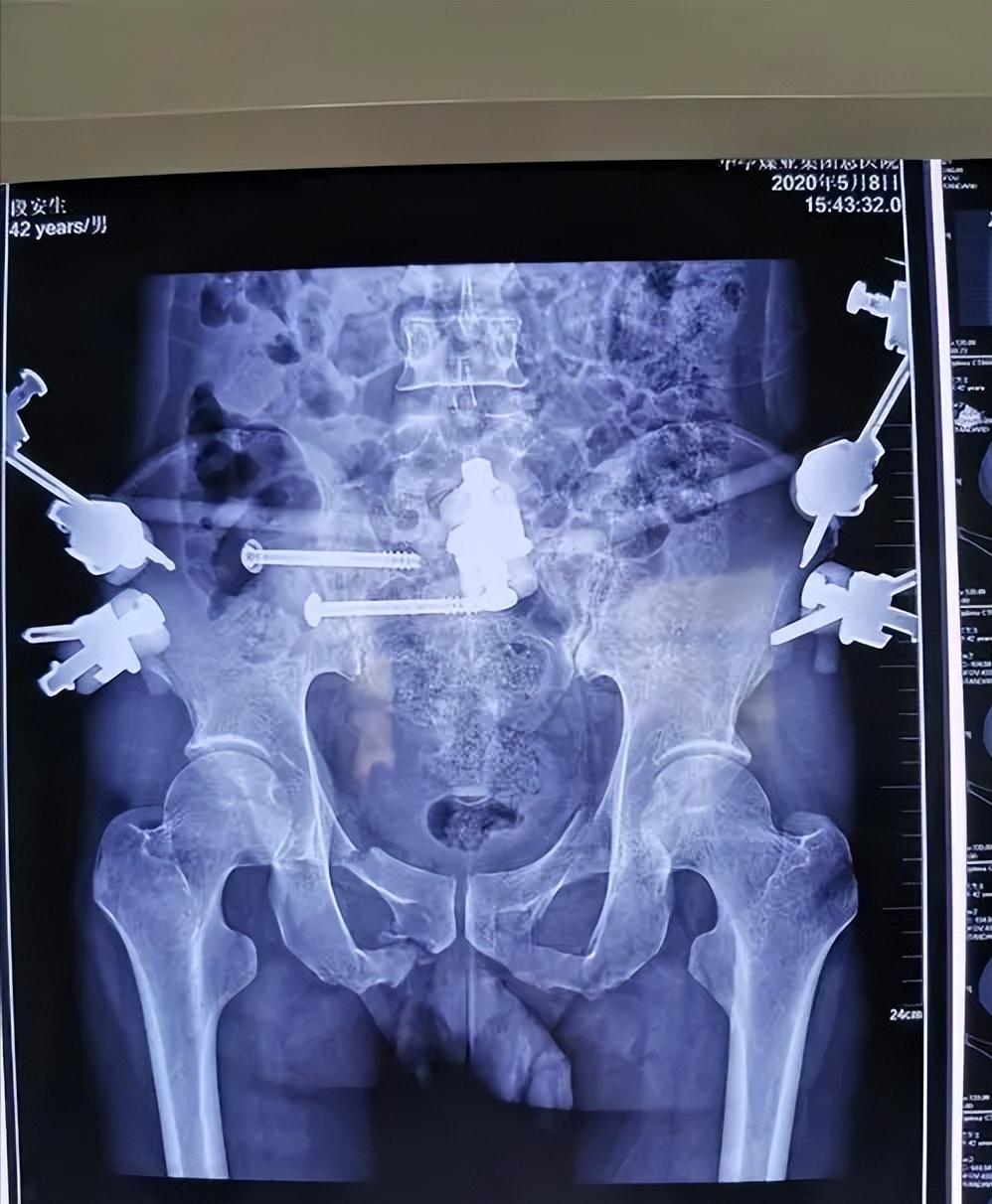 骨盆后环损伤后，新型螺钉的不同内固方法各有何优势？哪种方法好