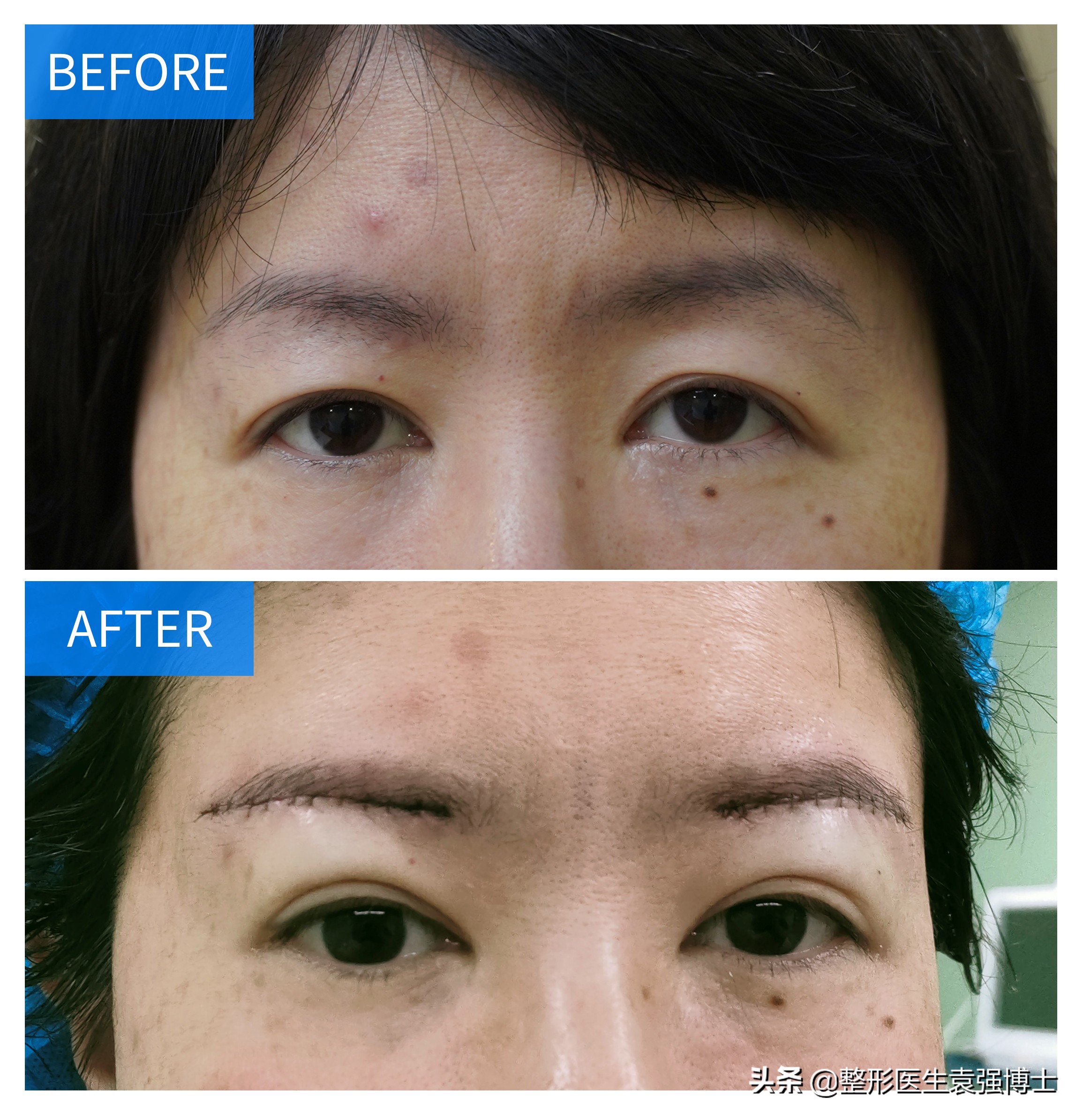 做完提眉后感觉很奇怪,做完提眉疼多久