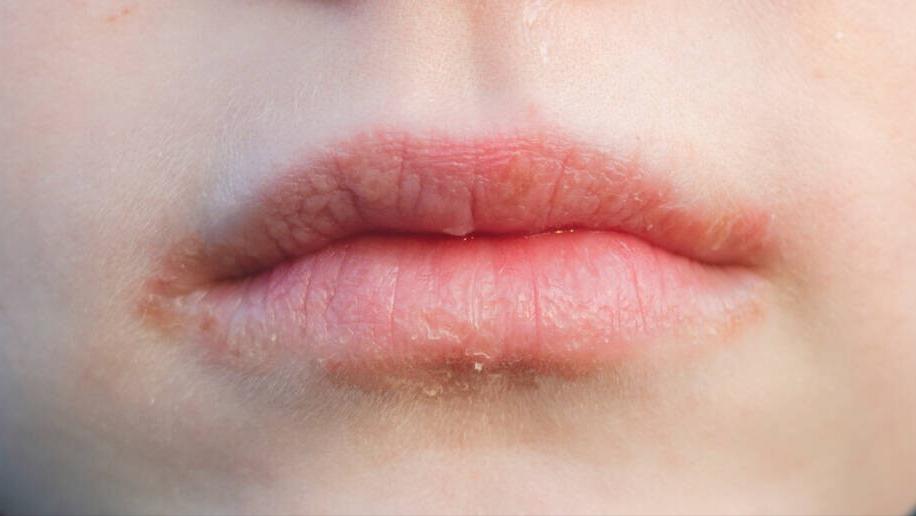 咳嗽与肺热和上火有什么关系,肺热咳嗽肺火旺怎么办