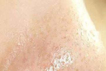 毛孔大得像“筛子”，你的毛孔是怎么一步步撑大的？