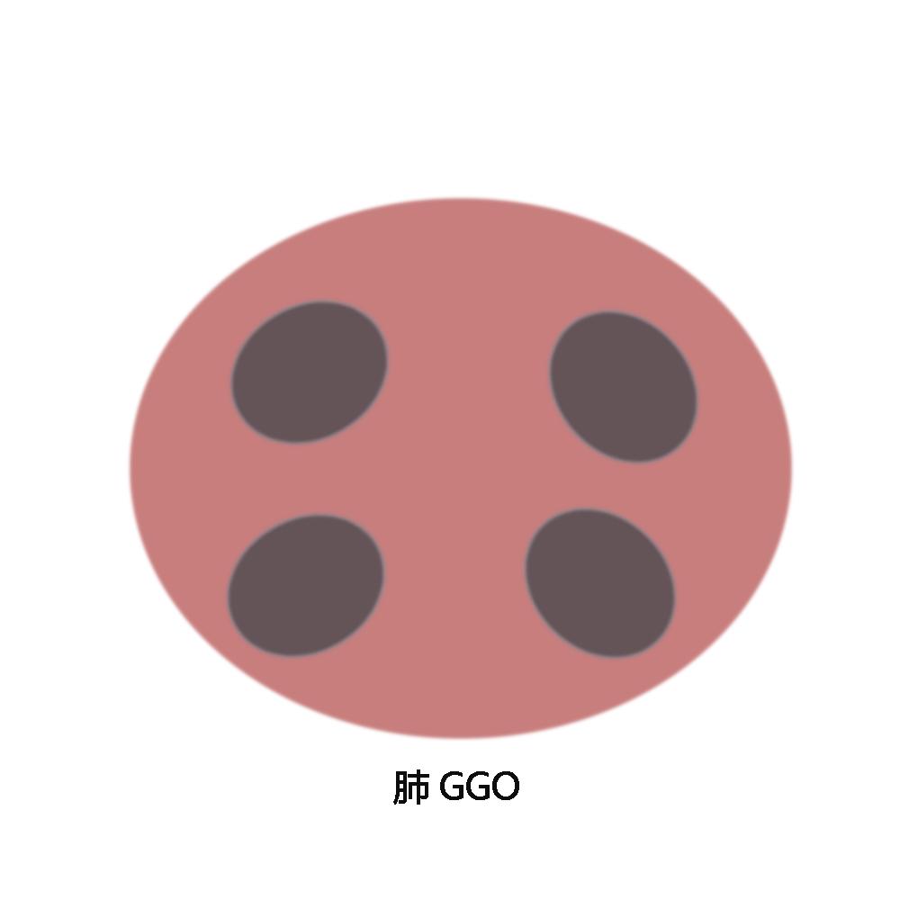 肺高危磨玻璃结节怎么治疗最好,肺磨玻璃结节影微创手术