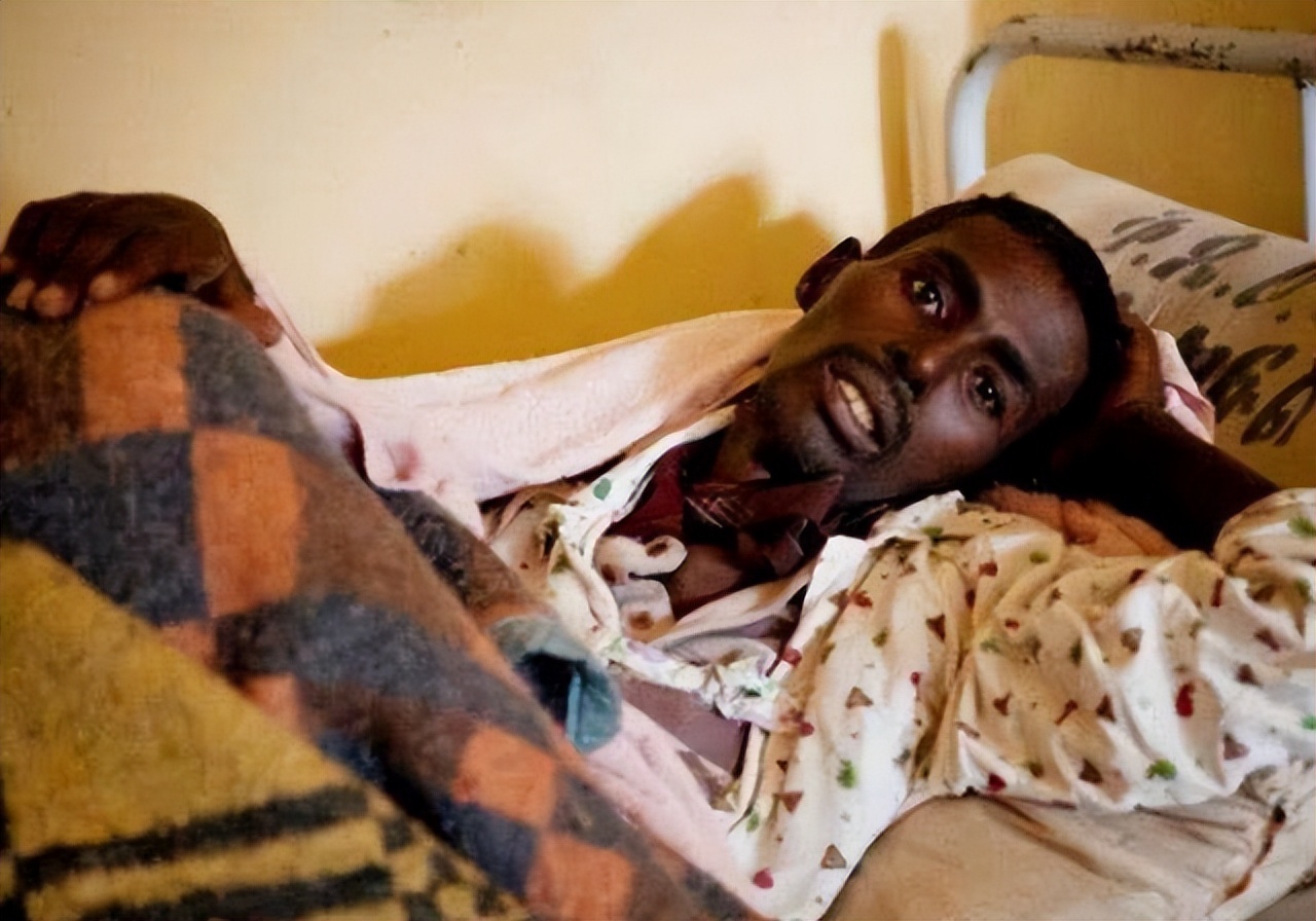 艾滋病的口腔症状有哪些？不妨查看自己是否有这3个“迹象”