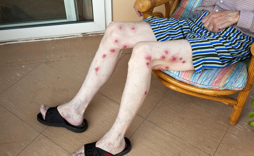 辟谣！梅毒检查阳性，能通过生活接触传染？医生告诉你答案