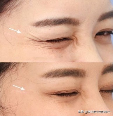 停止打玻尿酸脸会松弛下垂吗,停止打溶脂针后会怎样