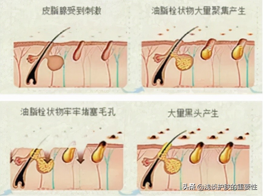 鼻子出油后补妆草莓鼻特明显,油性皮肤草莓鼻怎么改善