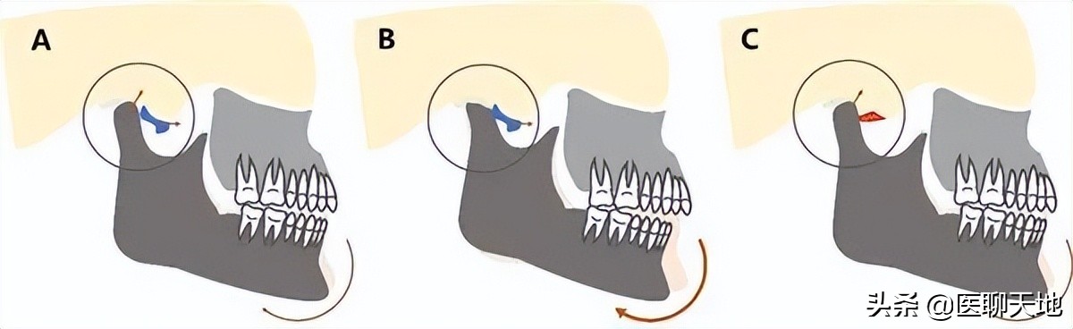 牙齿重复咬到一个地方是什么原因,最近两颗牙齿老咬在一起什么原因