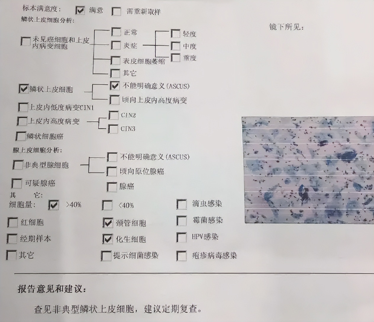 定期筛查宫颈癌有多重要？