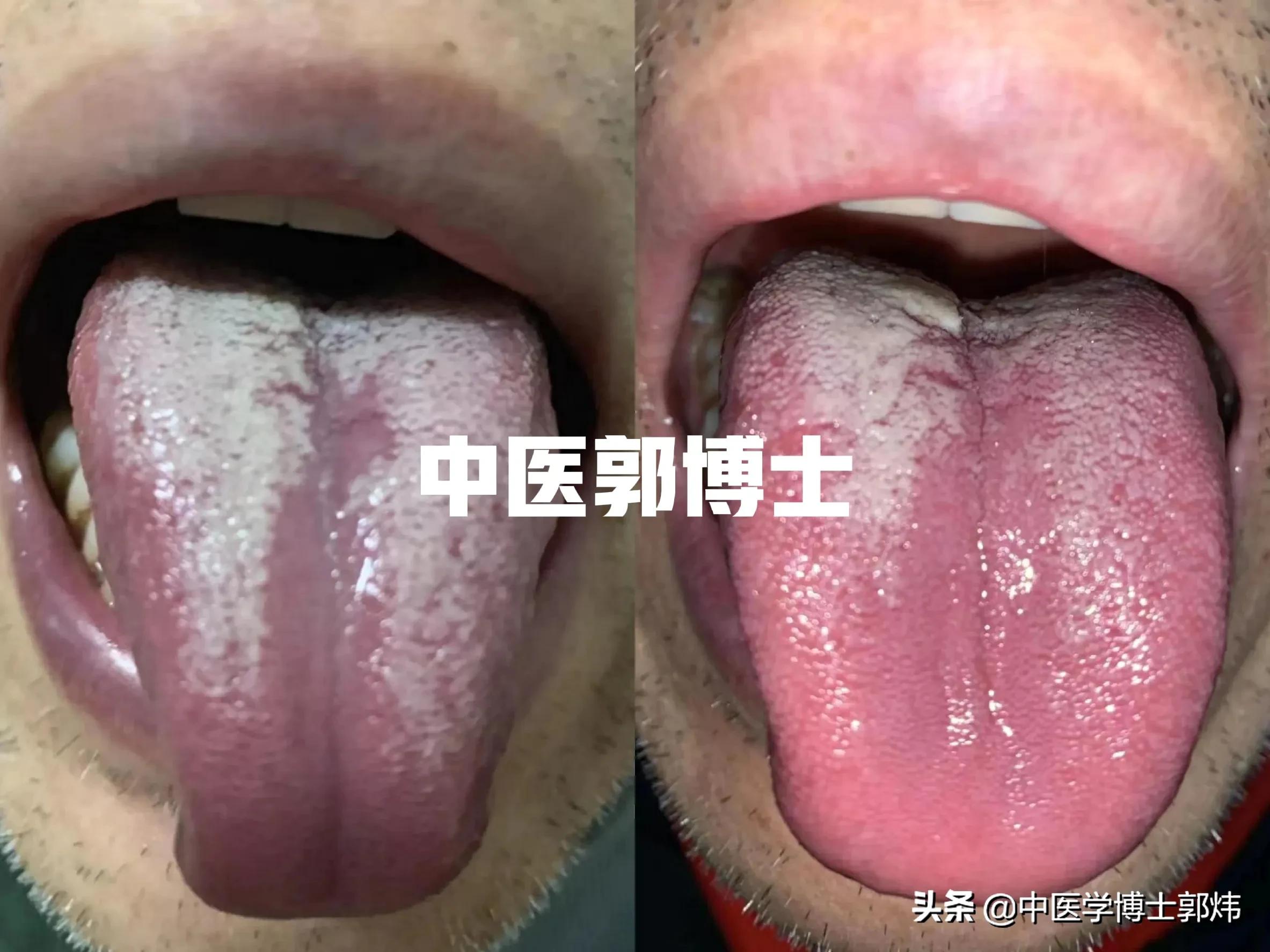 化疗后身体虚弱但要二次化疗,化疗后各项指标低需要输血吗