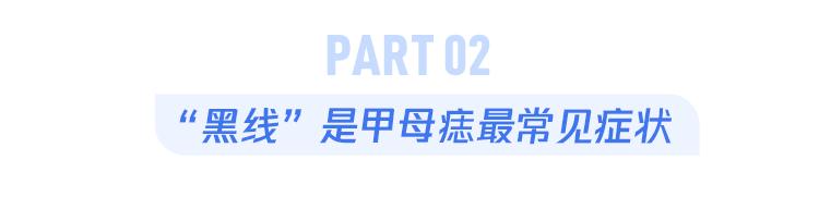 指甲上有黑线的预兆,指甲上有小黑线要注意哪些