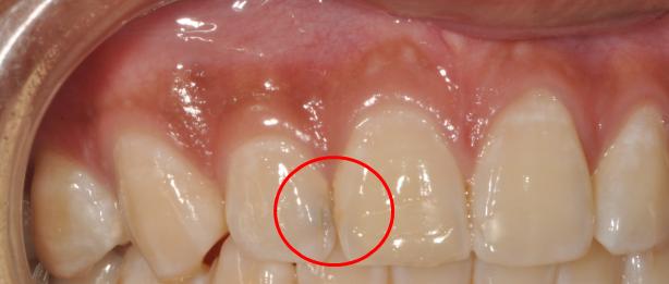 邻面龋为什么医生只补了一颗,邻面浅龋为什么医生不建议补牙