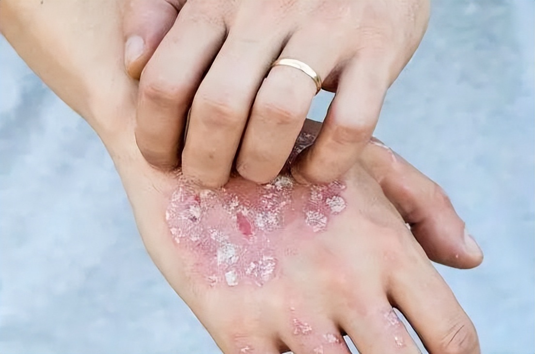 真菌清热除湿的口服中成药,细菌性皮肤病的常用药