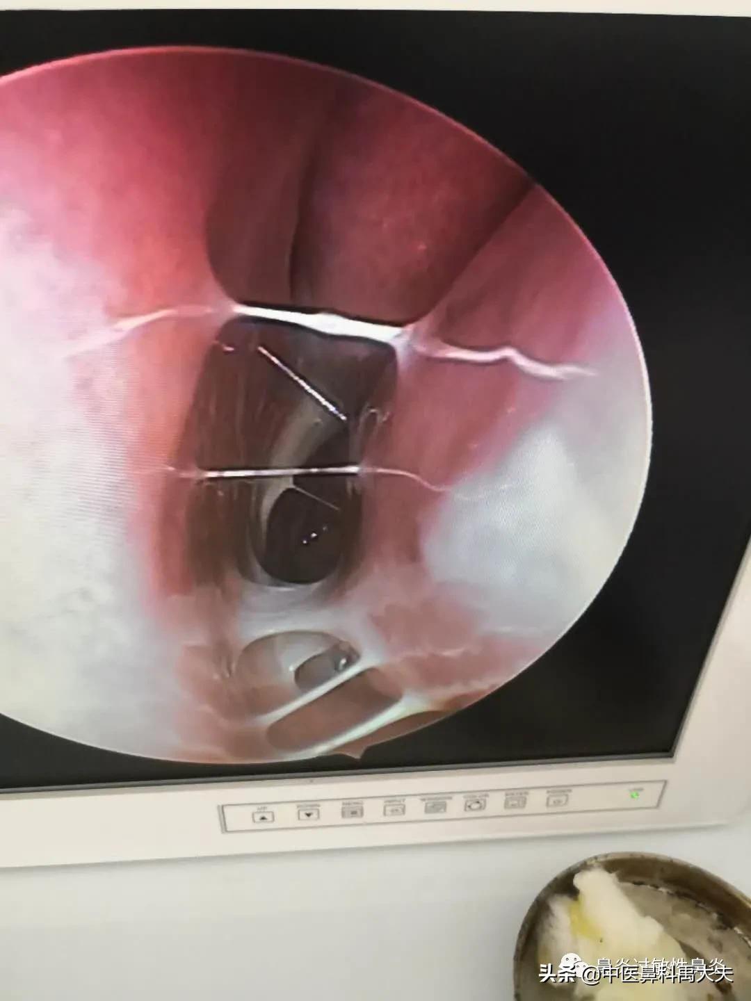 慢性鼻炎可以自愈么视频,慢性鼻炎出血怎样自愈