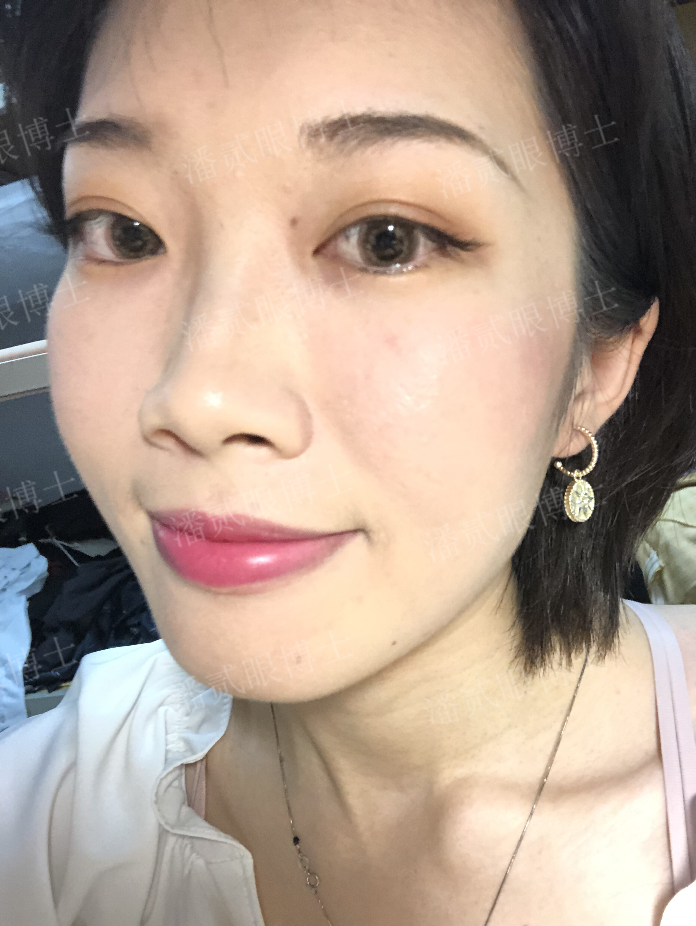 广州姑娘变美后亲述：“我的双眼皮切得很小，只有1厘米多一点”