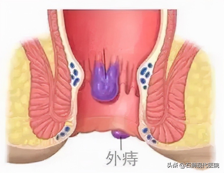 大便时肛门疼痛怎么治疗,大便肛门疼痛用什么药好得快