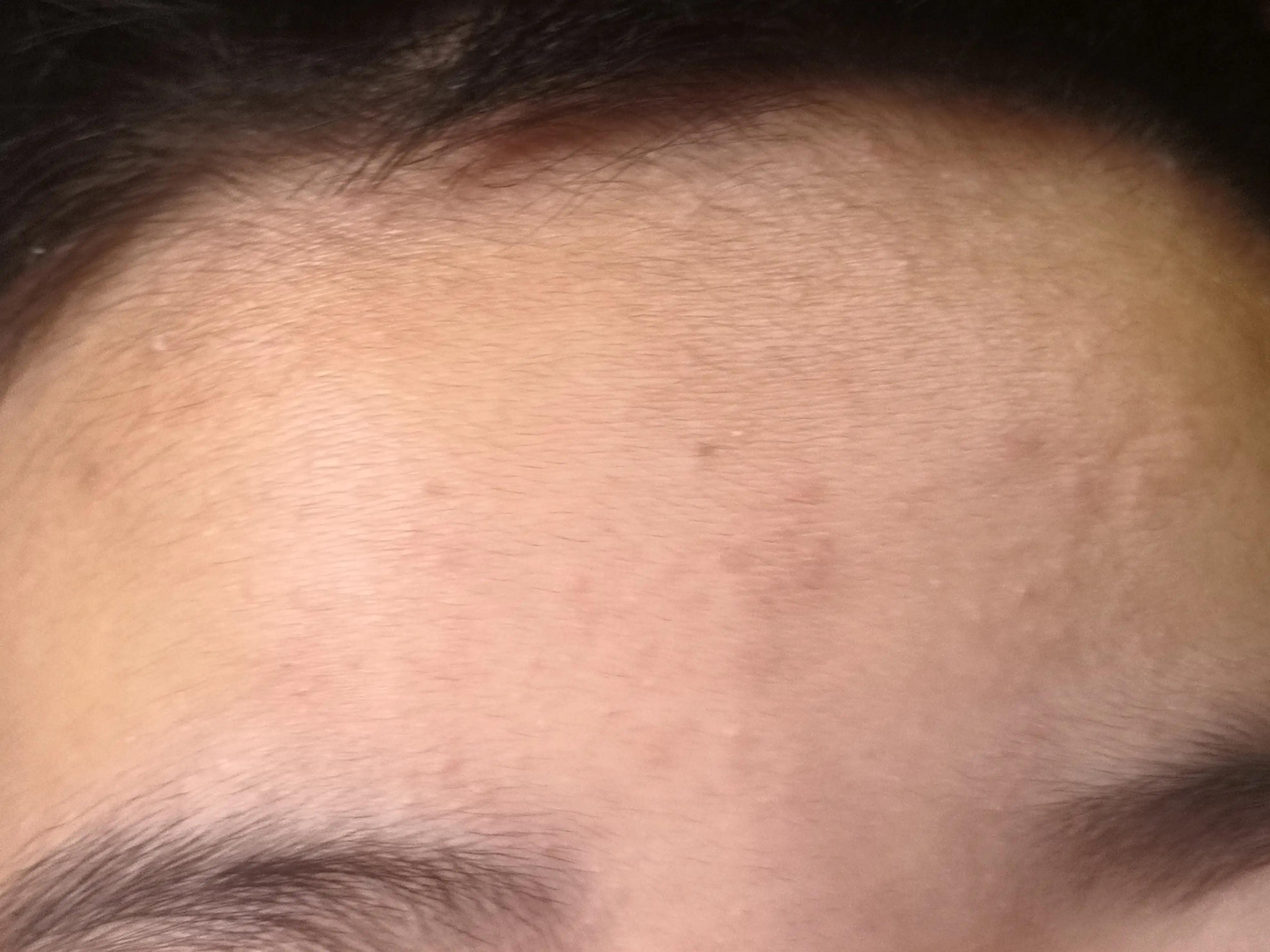 偶然发现对付青春痘的特强面霜，太管用了