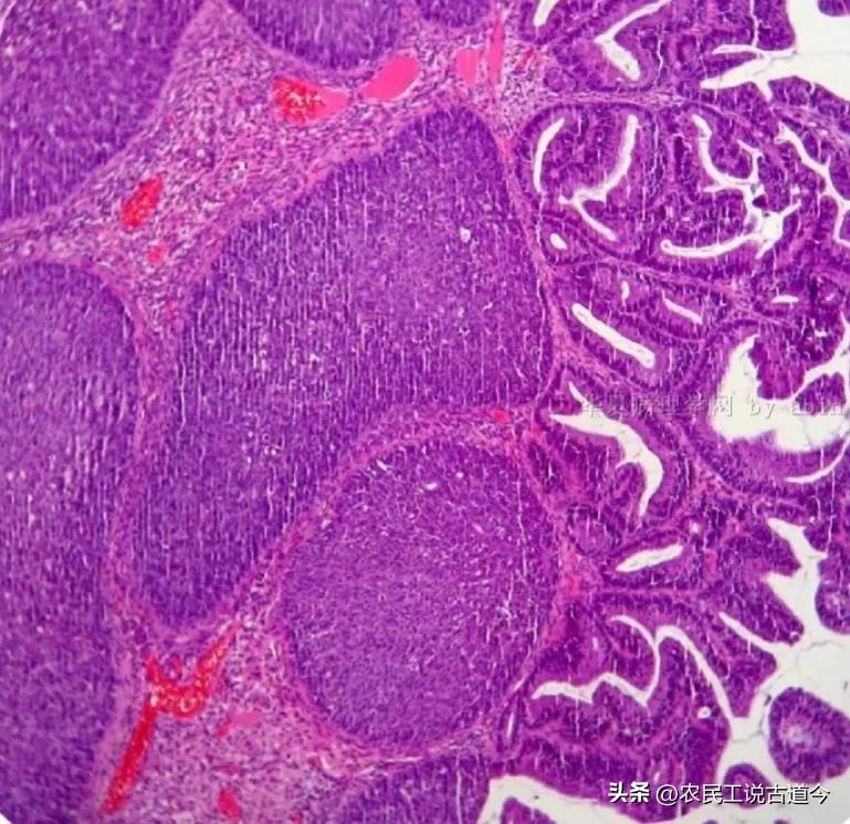 活检报告子宫颈慢性炎症,宫颈活检能查出子宫内的病吗