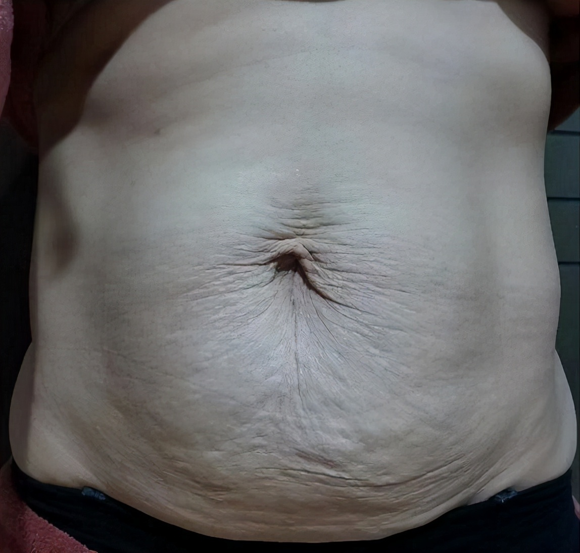 余文林整形视频全集,腹壁整形余文林