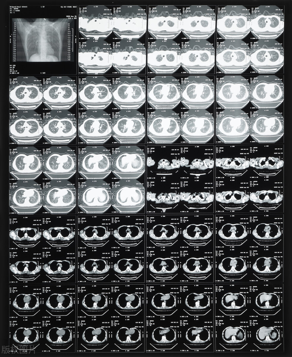 新冠后需要拍肺部ct吗,新冠之后需要拍片子吗